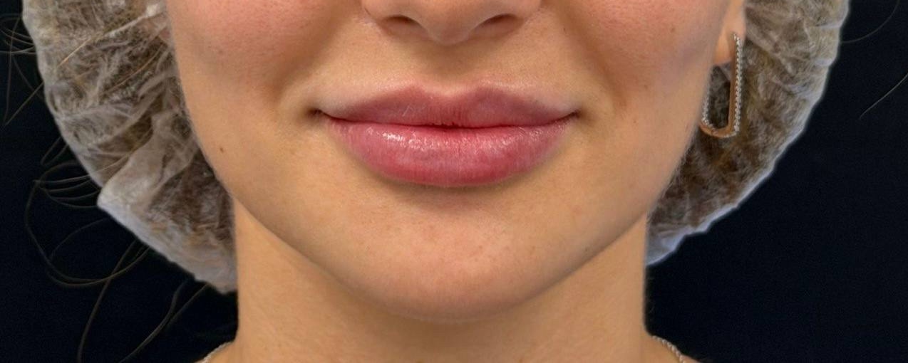 контурная пластика губ спб