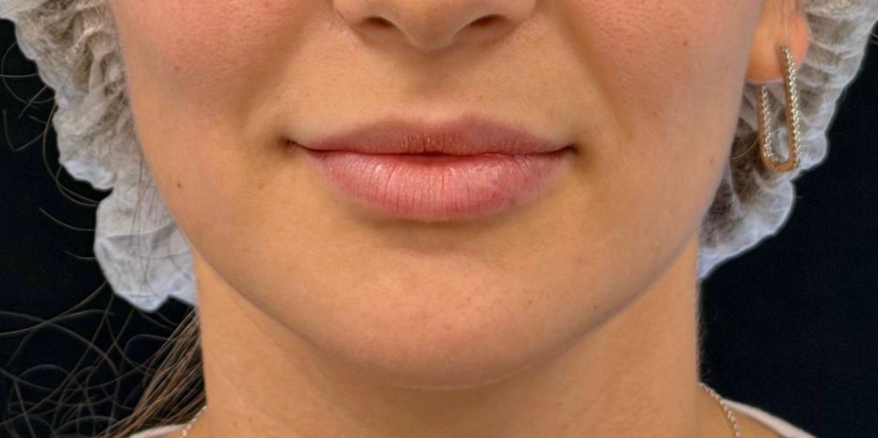 увеличение губ